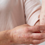 skin allergy treatment